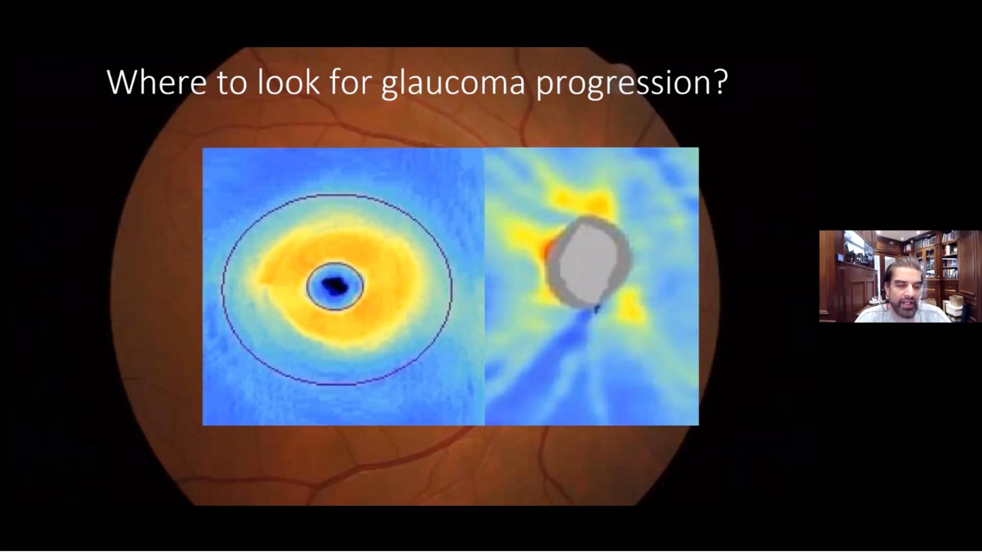 OCT utilization and prioritization for glaucoma management post-COVID-19