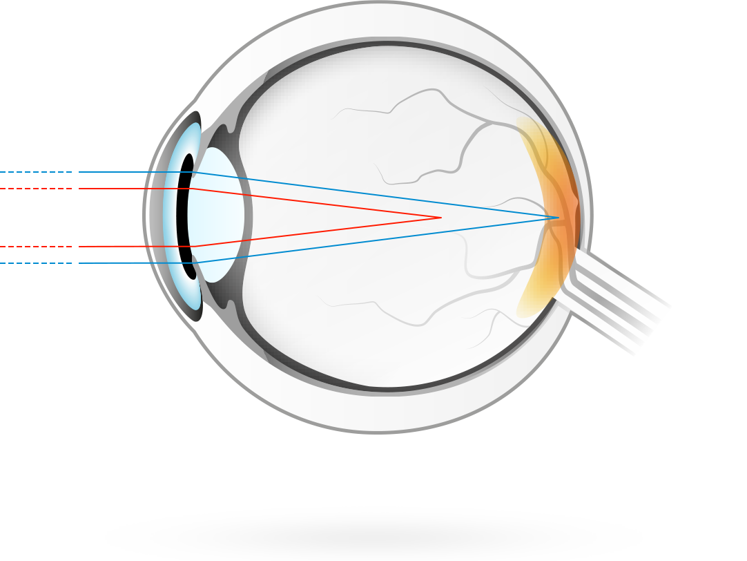 L&apos;astigmatisme – condition dans laquelle la surface de la cornée présente une courbure asymétrique, de sorte que les rayons lumineux sont focalisés en deux points au lieu d&apos;un seul, ce qui cause une vision floue
