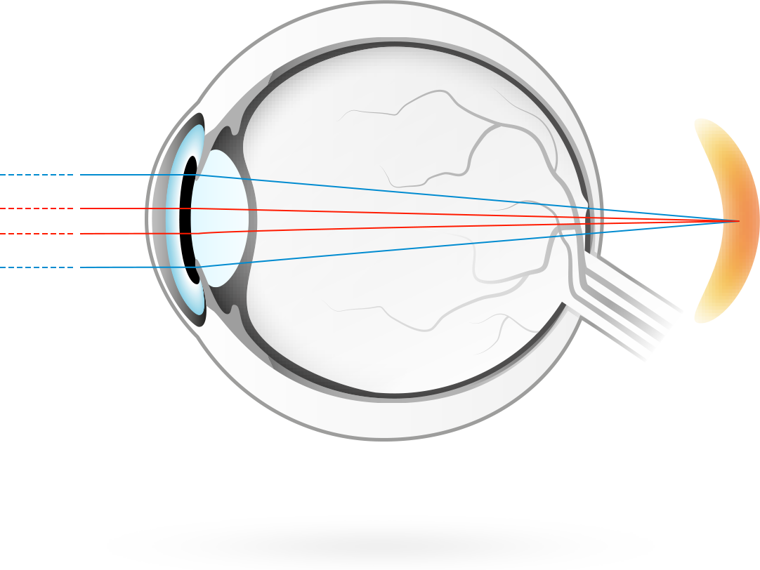 L&apos;hypermétropie – condition dans laquelle la focalisation des images visuelles se fait en arrière de la rétine, ce qui rend la vue à de près plus floue, car l&apos;œil a du mal à focaliser les objets proches
