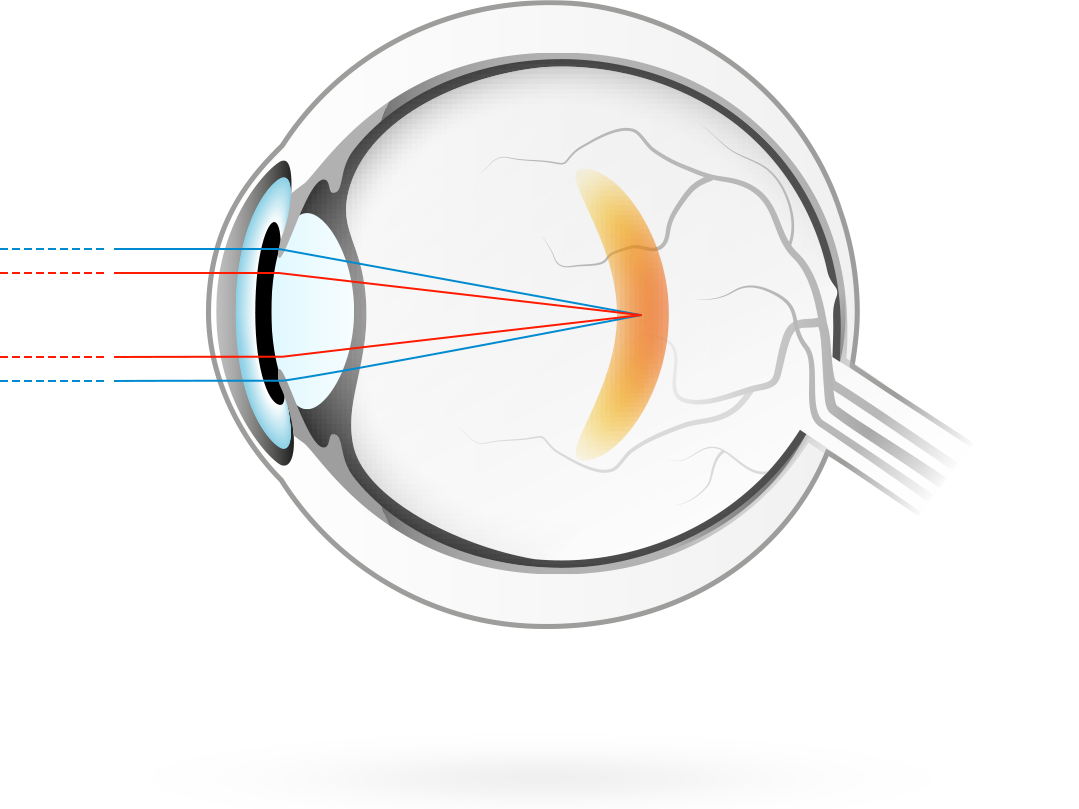 La myopie – condition dans laquelle la focalisation des images visuelles se fait en avant de la rétine, ce qui rend la vue à distance plus floue