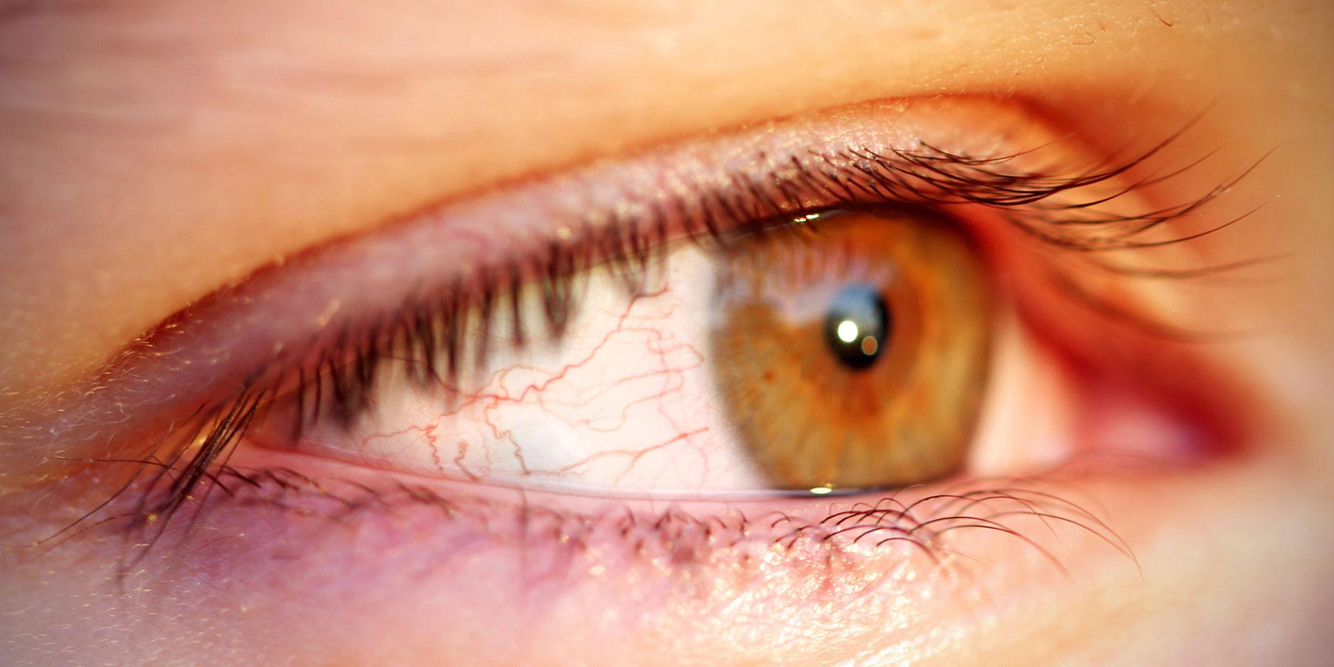 Yeux rouges