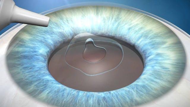 Anaesthesia prior to cataract surgery.