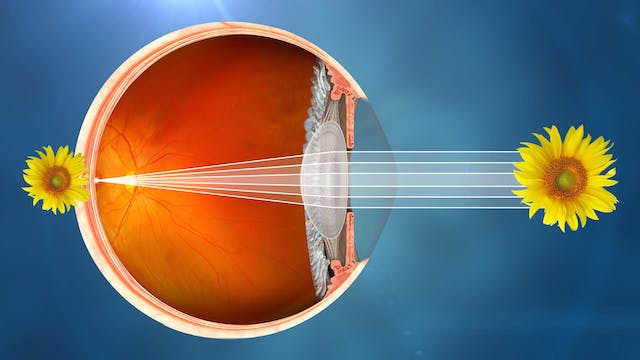 What is Cataract - Healthy vision