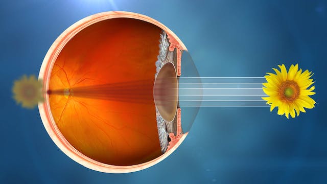 What is Cataract - Vision impaired by cataract