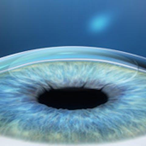 Correction du défaut de réfraction