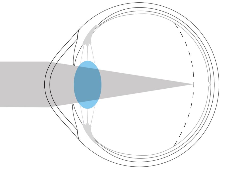 Illustration d&apos;un œil myope qui montre que la lumière est focalisée devant la rétine.