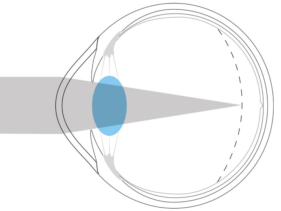 Illustration d’un œil myope qui montre que la lumière est focalisée devant la rétine.