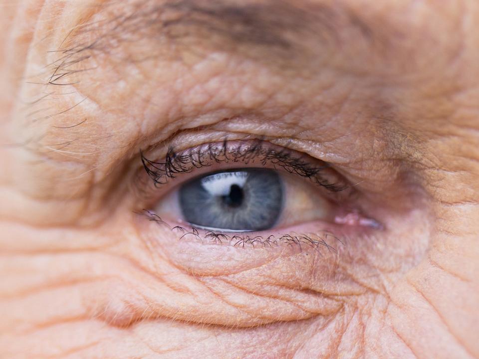 Image showing photoaging around the eyes.