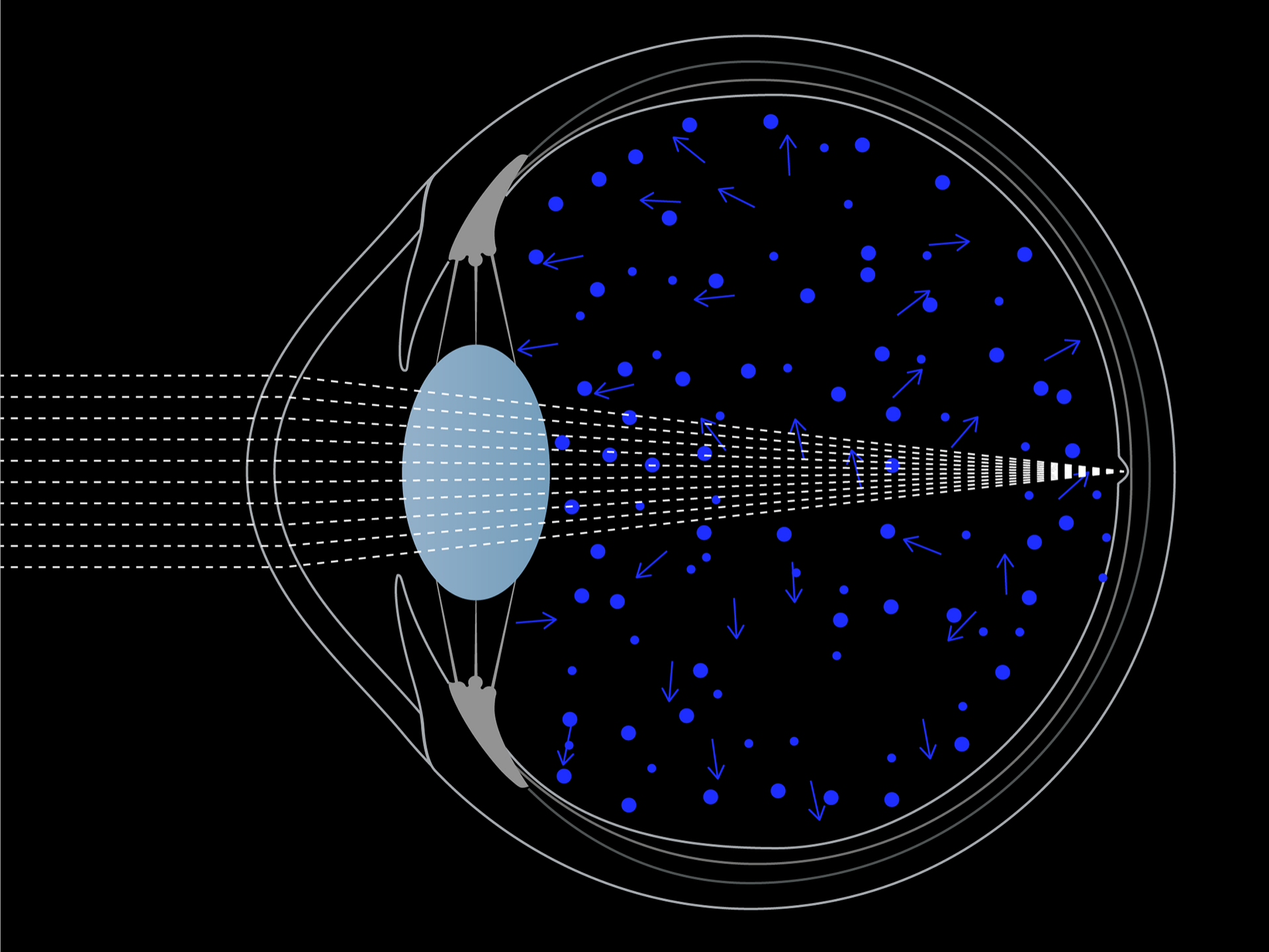 Illustration of light entering the eye, showing how blue light scatters more throughout the eye than white light. 